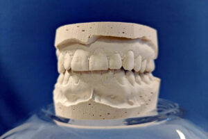 Plaster cast of teeth on blue background